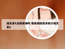 维生素k治银屑病吗 银屑病脱屑多缺少维生素k