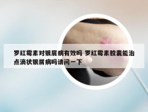 罗红霉素对银屑病有效吗 罗红霉素胶囊能治点滴状银屑病吗请问一下