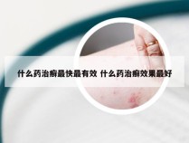 什么药治癣最快最有效 什么药治癣效果最好