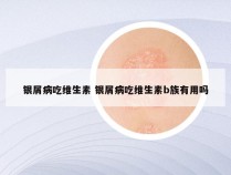 银屑病吃维生素 银屑病吃维生素b族有用吗