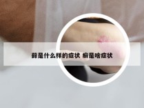 藓是什么样的症状 癣是啥症状