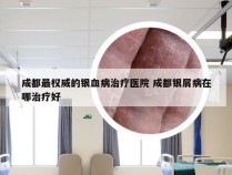 成都最权威的银血病治疗医院 成都银屑病在哪治疗好