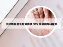 衡阳银屑病治疗需要多少钱 银屑病专科医院