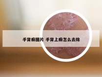 手背癣图片 手背上癣怎么去除