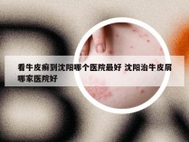 看牛皮癣到沈阳哪个医院最好 沈阳治牛皮屑哪家医院好