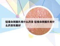 轻度白斑图片用什么药膏 轻度白斑图片用什么药膏效果好