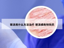 银消用什么方法治疗 银消病有特效药