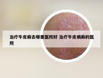 治疗牛皮癣去哪里医院好 治疗牛皮病癣的医院