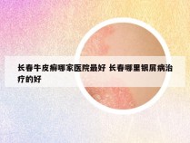 长春牛皮癣哪家医院最好 长春哪里银屑病治疗的好