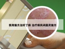 我用偏方治好了癣 治疗癣民间最灵偏方