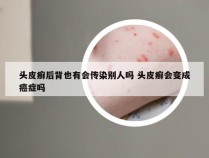 头皮癣后背也有会传染别人吗 头皮癣会变成癌症吗