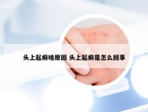 头上起癣啥原因 头上起癣是怎么回事