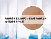 头皮癣症状怎么治疗可以根治吗 头皮癣怎么治才能除根用什么药