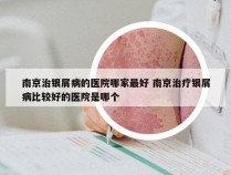 南京治银屑病的医院哪家最好 南京治疗银屑病比较好的医院是哪个