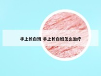 手上长白班 手上长白班怎么治疗