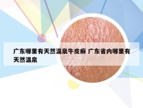 广东哪里有天然温泉牛皮癣 广东省内哪里有天然温泉