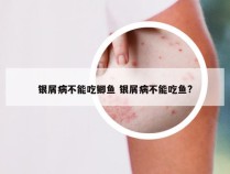 银屑病不能吃鲫鱼 银屑病不能吃鱼?