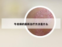 牛皮癣的最新治疗方法是什么