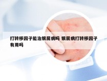 打转移因子能治银屑病吗 银屑病打转移因子有用吗