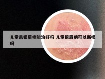 儿童患银屑病能治好吗 儿童银屑病可以断根吗