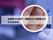 白斑用308治疗一般照几次 白斑照308几次会见效