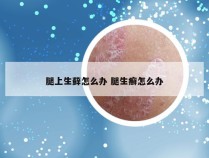 腿上生藓怎么办 腿生癣怎么办