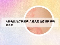 六神丸能治疗银屑病 六神丸能治疗银屑病吗怎么吃