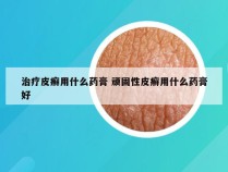 治疗皮癣用什么药膏 顽固性皮癣用什么药膏好