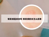 银屑病是掉皮吗 银屑病脱皮怎么回事