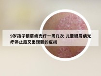 9岁孩子银屑病光疗一周几次 儿童银屑病光疗停止后又出现新的皮损