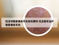 托法对银屑病关节炎有效果吗 托法替尼治疗银屑病关节炎