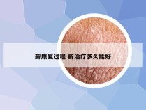 藓康复过程 藓治疗多久能好