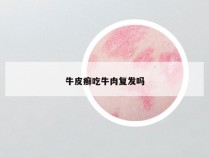 牛皮癣吃牛肉复发吗