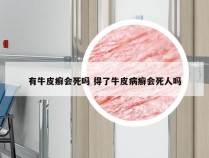 有牛皮癣会死吗 得了牛皮病癣会死人吗