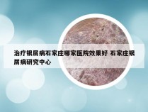 治疗银屑病石家庄哪家医院效果好 石家庄银屑病研究中心