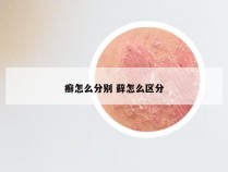 癣怎么分别 藓怎么区分