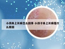 小孩身上长癣怎么回事 小孩子身上长癣是什么原因