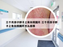 三个月孩子脖子上有白斑图片 三个月孩子脖子上有白斑图片怎么回事