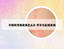 孕期突发银屑病怎么办 怀孕引起银屑病