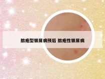 脓疱型银屑病预后 脓疱性银屑病