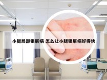 小腿局部银屑病 怎么让小腿银屑病好得快