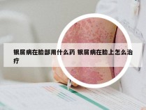 银屑病在脸部用什么药 银屑病在脸上怎么治疗