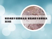 银屑病需不需要勤洗澡 银屑病需不需要勤洗澡洗脸