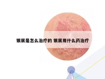 银屑是怎么治疗的 银屑用什么药治疗