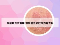 银屑病耳穴调理 银屑病耳朵放血作用大吗