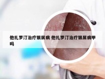 他扎罗汀治疗银屑病 他扎罗汀治疗银屑病甲吗