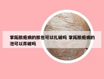 掌跖脓疱病的脓包可以扎破吗 掌跖脓疱病的泡可以弄破吗