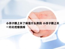 小孩子腰上长了癣是什么原因 小孩子腰上长一片红疙瘩很痒