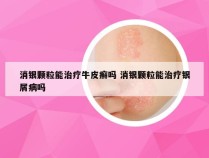 消银颗粒能治疗牛皮癣吗 消银颗粒能治疗银屑病吗