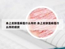 身上皮肤是癣是什么样的 身上皮肤是癣是什么样的症状